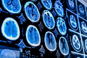nowy-lider-neurochirurgii-w-tarnowie-prof-jacek-szczygielski-kontynuuje-dziedzictwo-prof-maciejczaka